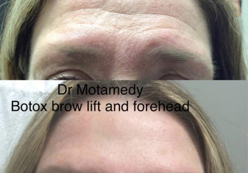 Before And After Botox
