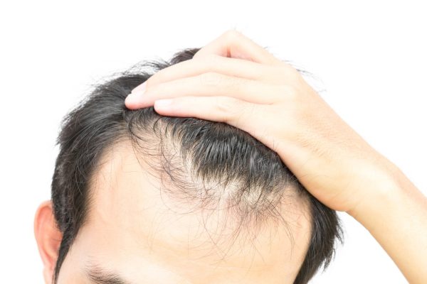 hair loss