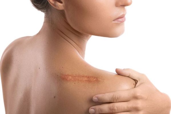 Scars/Strech Marks